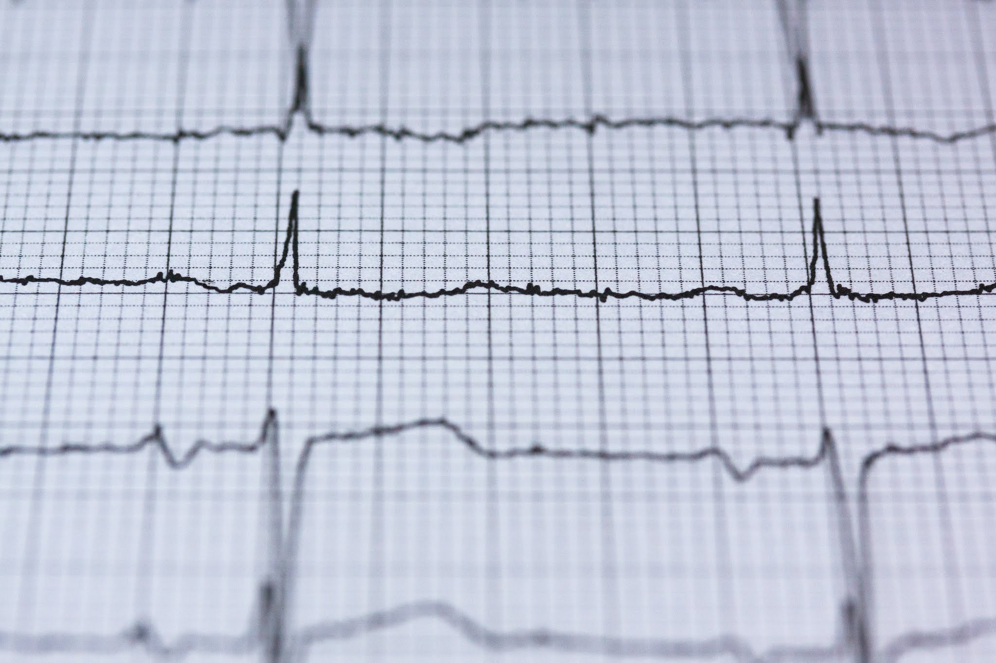 Tracés d'électrocardiogramme sur papier graphique médicale avec grille